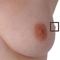 Lumps, bumps or thickening