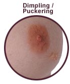 Dimpling / Puckering