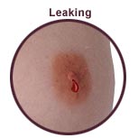 Leaking